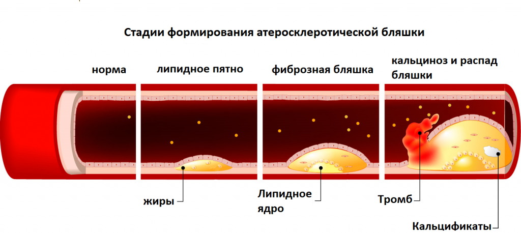 Правильное питание при атеросклерозе